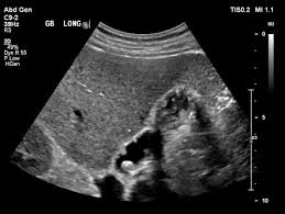cholesterolosis diagnosed through MRI