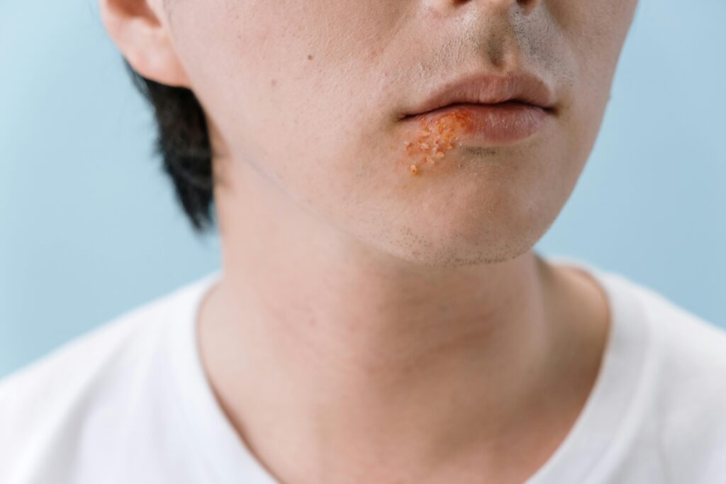 Fungal Skin Infection